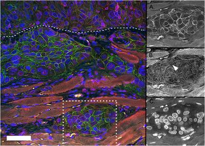 Integrins and Epithelial-Mesenchymal Cooperation in the Tumor Microenvironment of Muscle-Invasive Lethal Cancers